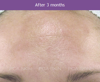 PCA 3 Months After