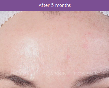PCA 5 Months After