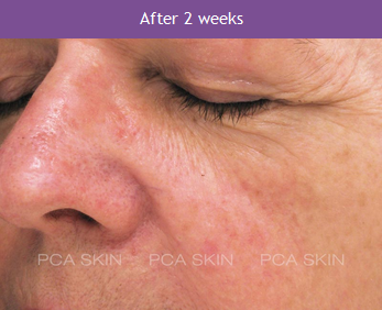 Rosacea - After