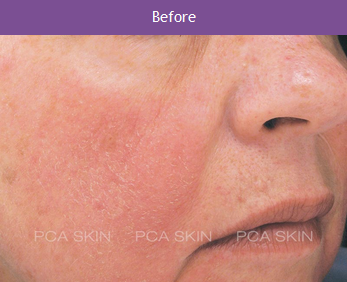 PCA Before
