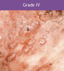 Acne - Grade 4