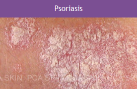 Psoriasis