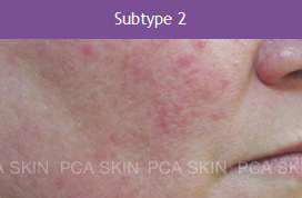 Rosacea - Type 2