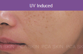 UV Induced